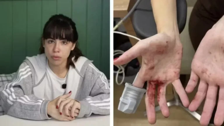 Atriz Nina Baiocchi mostra ferimentos após ser assaltada em SP