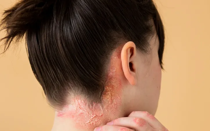 Dermatite causada por reação alérgica